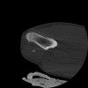 SPORK, NICO - 22.03.1976 - 02.08.2022 - CT obere Extremität - 17:51:17